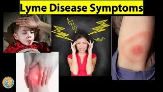 Signs and Symptoms of Lyme Disease