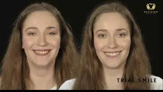 What is a Trial Smile?