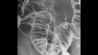 OSCE: Gastrointestinal Images You Must Know (For USMLE, MBBS, MCCQE & PLAB)