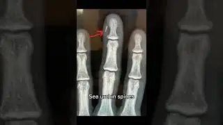 Life as a hand surgeon #Screw #LooseScrew #Surgeon #Dr #MedicalStudent #Nurse #SeaUrchin #Hand