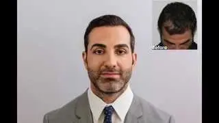 Hair Transplant – Dr. Baubac Hayatdavoudi of Alvi Armani
