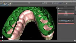 Hacking the Blue Sky Bio Digital Denture Software to Make Nightguards