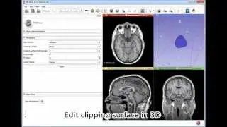 Volume cropping with dynamic 3D surface in 3D Slicer
