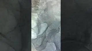 Control 11F Mechanical Thrombectomy System with Large Clot/Emboli
