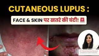 Cutaneous Lupus : Face & Skin पर खतरे की घंटी! | What is Cutaneous Lupus | Dr. Neeharika Goyal