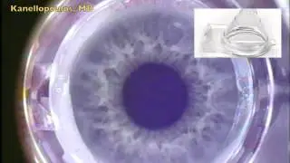 LASIK flap digital analysis parameter evaluation - Video abstract: 43396