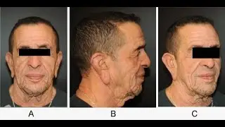 Cutis Laxa (Inelastic Skin) ; Definition, Symptoms, Causes, Diagnosis, Treatment