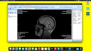 MicroDicom DICOM Viewer on macOS Sequoia  using Wine