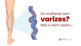 S&oacute; mulheres t&ecirc;m varizes? N&atilde;o &eacute; bem assim&hellip;
