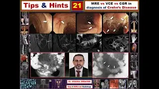 Tips & Hints 21 Crohn's Disease VCE, MRE & CGR
