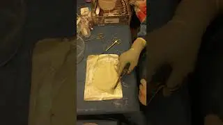 PrePectoral ADM