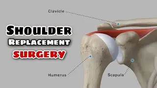 Shoulder bone replacement surgery 3D video | How it happens watch in video #surgery #video