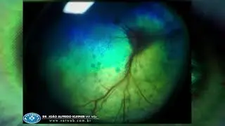 Retinal dysplasia in a dog