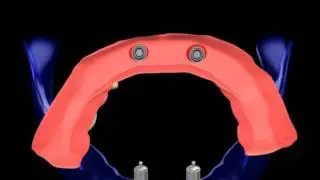 Overdenture with ball attachments