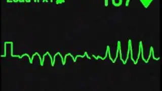 Torsades de Pointes - ECG Simulator - Arrhythmia Simulator