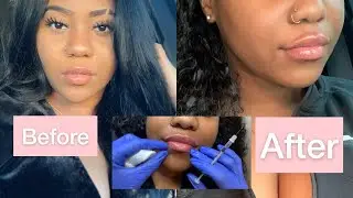 Black Girl/Woman Lip Filler Vlog! + Procedure Juvederm Ultra Plus