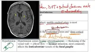 USMLE ACE Video 208: Comprehensive Guide to Ischemic Brain Stroke