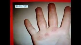 AUTOHEMOTHERAPY CURES ECZEMA. MULTIPLE LANGUAGES CC