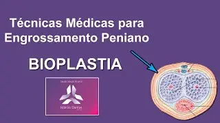 Engrossamento Peniano (Bioplastia Peniana, 