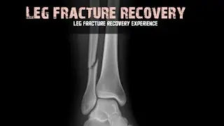 Leg fracture recovery | fracture recovery after 3 year | bone fracture recovery time @Vlogsarojk 