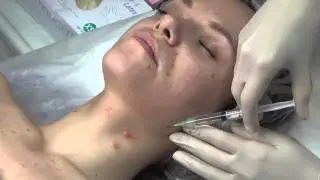 Биостимуляция кожи препаратом SKIN B  Без боли и следов