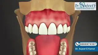 Dental Trauma: Tooth Intrusion Explained | Causes, Risks & Treatment | Dr. Sujeet Dental Care #video
