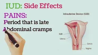 Intrauterine Device (IUD) Side Effects