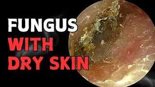 Fungus With Dry Skin Peeling