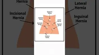 #Intestinal obstructions #nursing #shorts