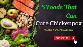 Top 5 Foods That Can Cure Chickenpox (Varicella).