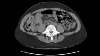 Radiology Rounds: CT of TRUE Situs Inversus (Abdominal/Pelvic CT)