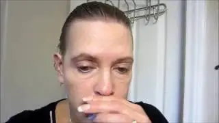 GRAPHIC! Lower Face & Neck Lift Surgery 2 Weeks Post-op