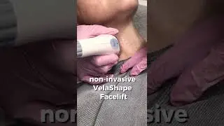 Velashape face lifting machine