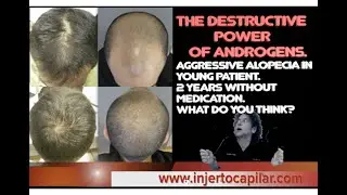 The destructive power of androgens.Aggressive alopecia in young patient.2yrs without med's.2916/2023