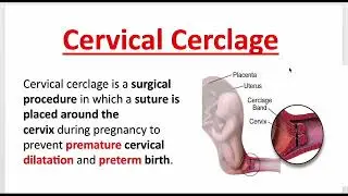 Cervical Cerclage V/S incompetence or Insufficiency #cervix #pregnancy #childbirth #Abortion