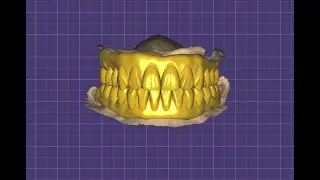 Upper lower full mouth designing for titanium bar and single piece implant in exocad