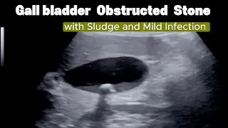 Gall bladder Infection with Sludge and Obstructed Stone  - Ultrasound