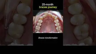 25 months braces journey. #braces #dentist #orthodontist