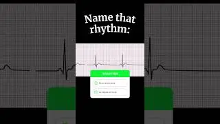 ECG Rhythm NCLEX Question: What&rsquo;s Your Move? ❤️
