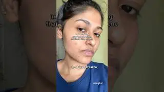 How I fixed my acne | Anua Azelaic Acid Serum #koreanskincaretips #acne #fyp