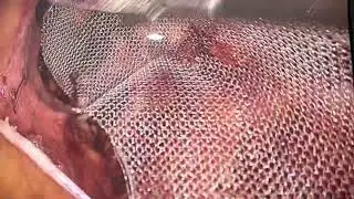 Ease of placing a dextile mesh in a hernia surgery