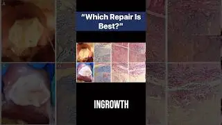 Open vs. Minimally Invasive Hernia Repair: Choosing the Right Approach