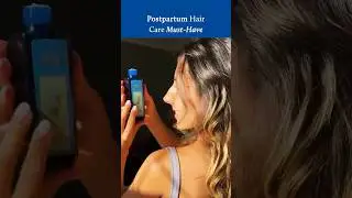 Postpartum Hair Loss |  My Honest Experience