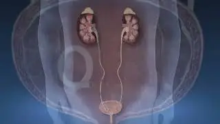 Kidney Stone PCNL Stent