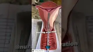 How to IUD insertion In Artificial Vagina #medical #nursing #indian #medicine