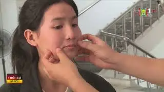 BVĐK Hà Đông tổ chức tháng hành động vì trẻ Khe hở môi nhân Kỷ niệm 7 năm mang lại nụ cười