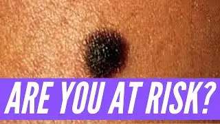 Could it be SKIN CANCER?? Learn the signs of what to look for with melanoma