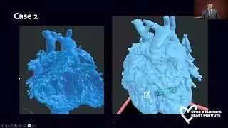 Anatomic Assessment of Complex Transposition Using Cross-Sectional Imaging and 3D+ Visualization