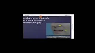Anatomical landmarks in complete denture @dr.daliaahmed6410