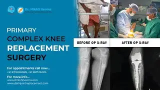𝐏𝐫𝐢𝐦𝐚𝐫𝐲 𝐂𝐨𝐦𝐩𝐥𝐞𝐱 𝐊𝐧𝐞𝐞 𝐑𝐞𝐩𝐥𝐚𝐜𝐞𝐦𝐞𝐧𝐭 𝐒𝐮𝐫𝐠𝐞𝐫𝐲 | 𝐃𝐫 𝐍𝐢𝐤𝐡𝐢𝐥 𝐕𝐞𝐫𝐦𝐚 𝐁𝐞𝐬𝐭 𝐎𝐫𝐭𝐡𝐨𝐩𝐞𝐝𝐢𝐜 𝐒𝐮𝐫𝐠𝐞𝐨𝐧 𝐢𝐧 𝐃𝐞𝐥𝐡𝐢